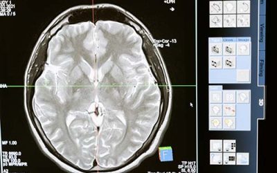 Transformative Potential of Hyperbaric Oxygen Therapy for Traumatic Brain Injury