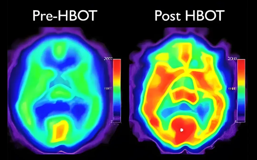 pre-hbot-vs-post-hbot-brain-scans