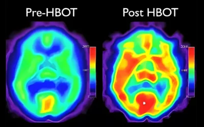 Hyperbaric Oxygen Therapy Helps Brain Health by enhancing blood flow to the brain!