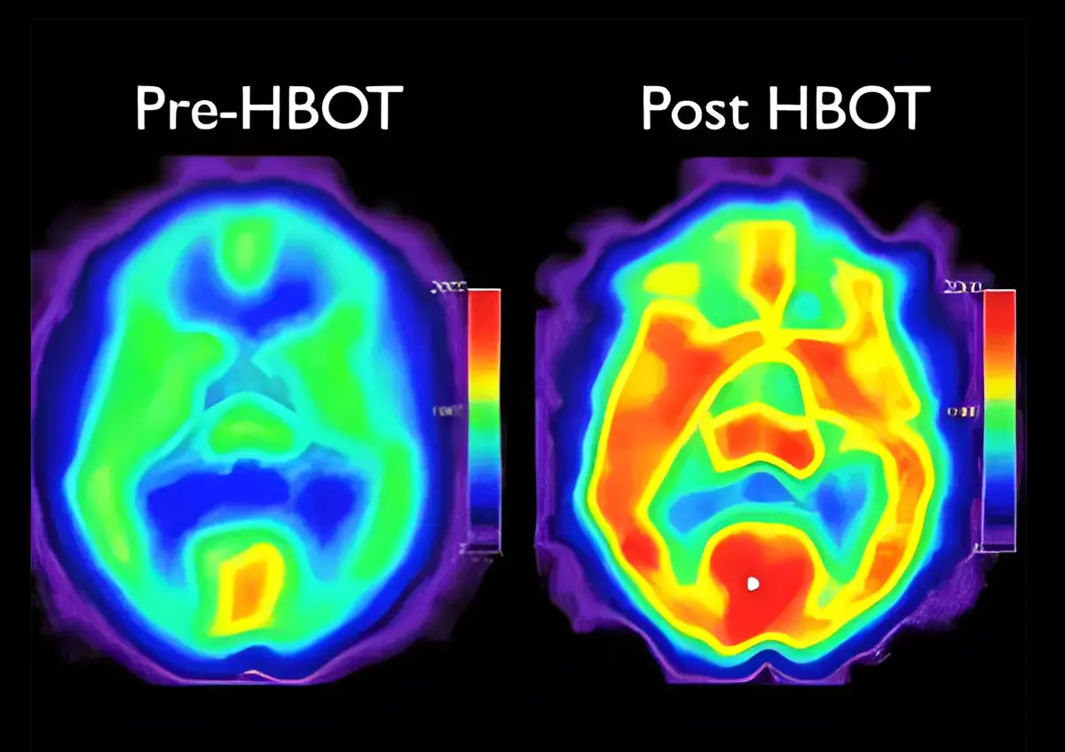 pre-hbot-vs-post-hbot-brain-scans