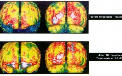 The Physiological Benefits of HBOT have been shown to help: