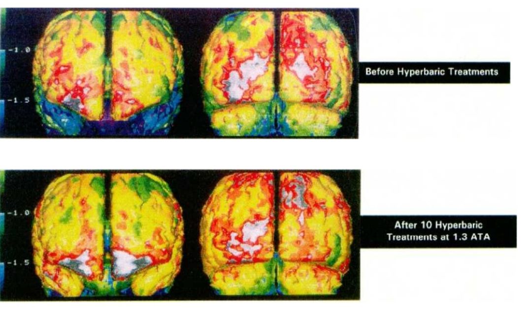 Clinical Study: Mild Hyperbarics for Impaired Brain Function