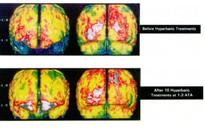 Clinical Study: Mild Hyperbarics for Impaired Brain Function