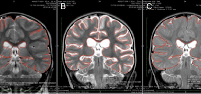 Drowning and Anoxic Brain Injury